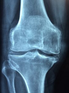 health benefits of collagen -- knee xray